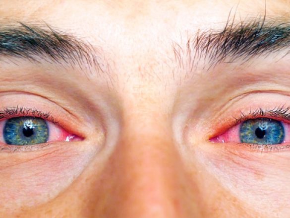 ¿Qué causa que los ojos se pongan rojos?
