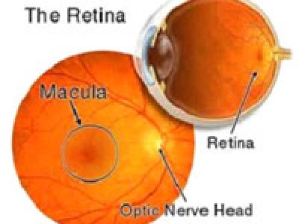 Desprendimiento de retina