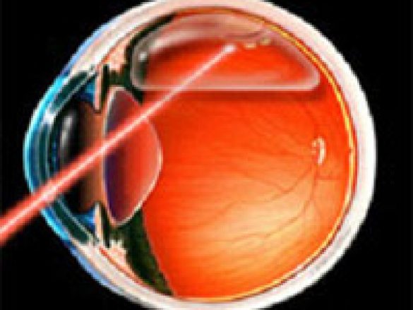 Tratamiento para el desprendimiento de retina