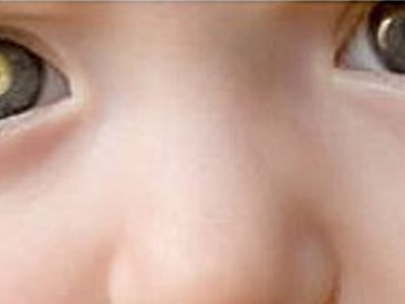 ¿Qué es retinoblastoma?