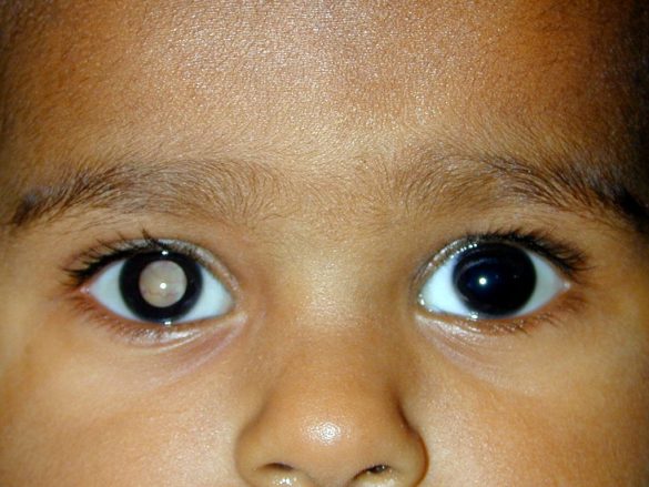 Retinoblastoma: El cáncer ocular más común en niños