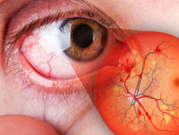 ¿Qué és Retinopatía Diabética (RD)?