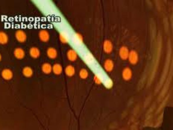 ¿Qué es la Retinopatía Diabetica?