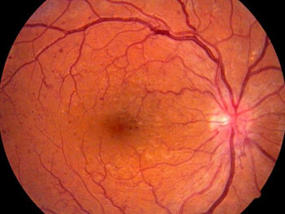 Retinopatía Diabética