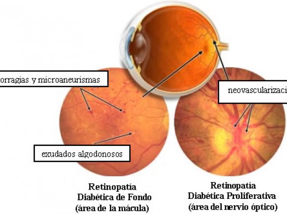 ¿Qué es la Retinopatía Proliferativa?