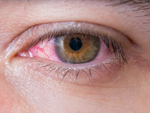 Retinopatía Hipertensiva: Lo que tus ojos dicen de tu presión