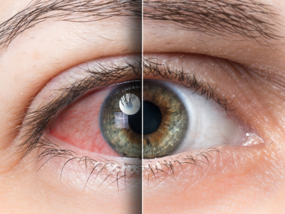 ¿Qué es el síndrome del ojo seco?