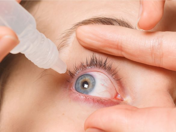 ¿Qué es el síndrome del ojo seco?