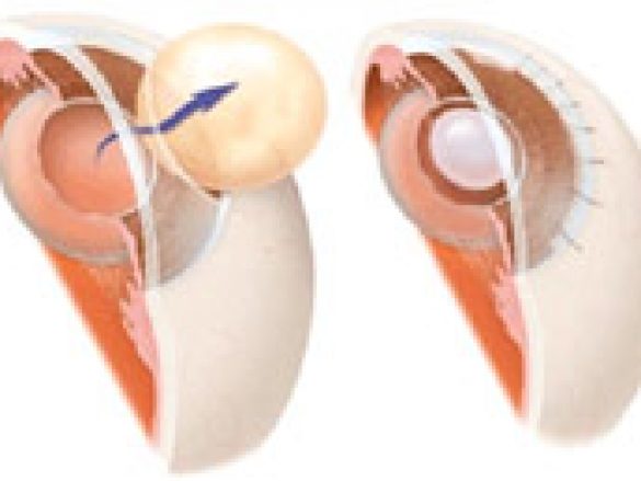 Cuál es el tratamiento para la Catarata