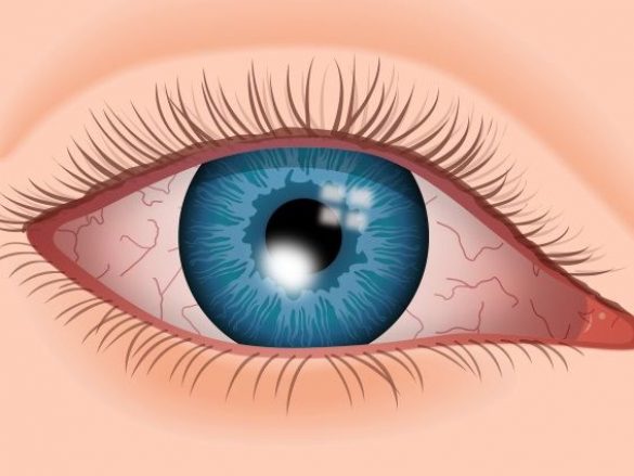 Causas más frecuentes de úlceras e infecciones corneales