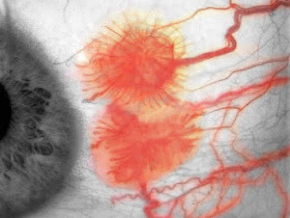 Várices conjuntivales