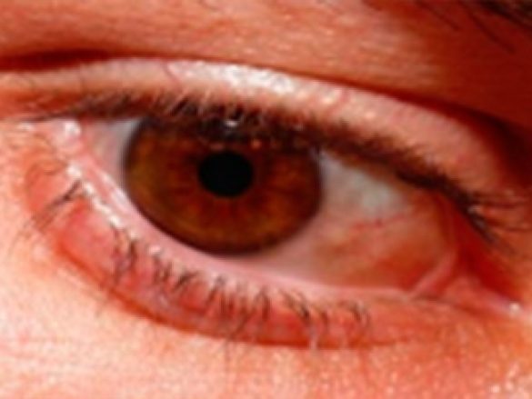 Obstrucción de la vía lagrimal