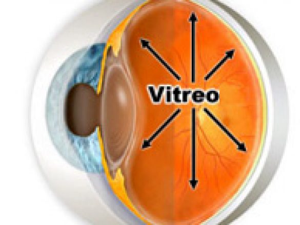 ¿Qué es el Desprendimiento de Vítreo?