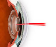 ¿Qué enfermedades pueden tratarse con cirugía laser?