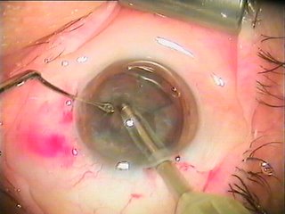 ¿Cuáles son los riesgos de la cirugía para las cataratas?