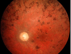 Retinosis pigmentaria
