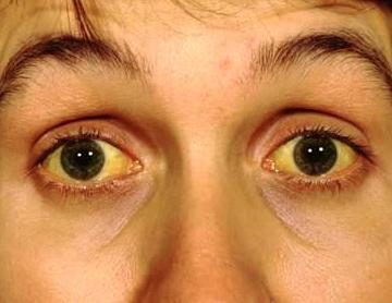 Ictericia u Ojos amarillos