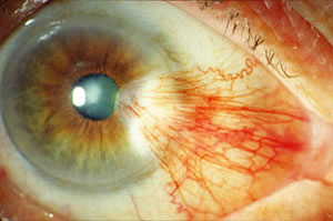 ¿Qué es Pterigión o Carnosidad?