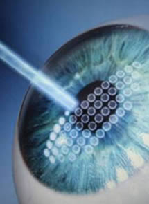 Los beneficios de la Cirugia Lasik