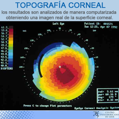 ¿Qué es la topografía corneal?