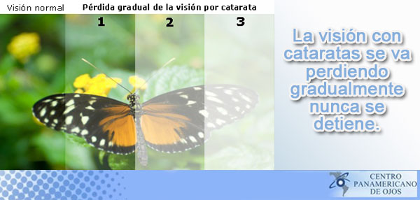 Cirugía de Cataratas