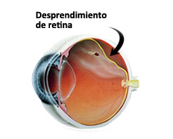Desprendimiento de retina