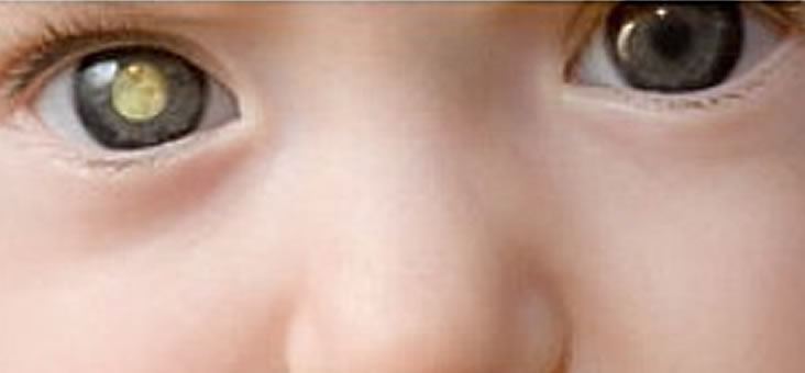 ¿Qué es retinoblastoma?