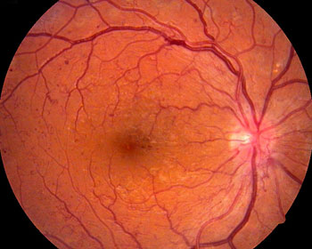 Retinopatía Diabética