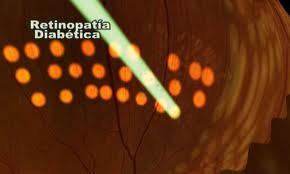 ¿Qué es la Retinopatía Diabetica?