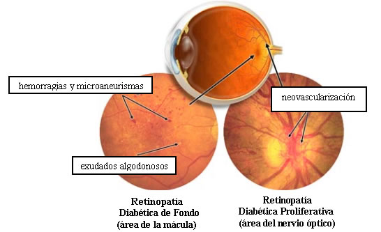 ¿Qué es la Retinopatía Proliferativa?