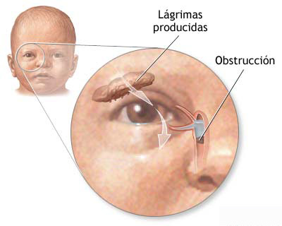 ¿Qué Es la Obstrucción del Conducto Lagrimal?