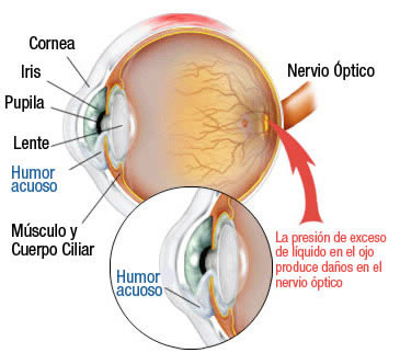 Tipos de glaucoma