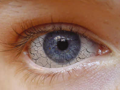 ¿Qué es el síndrome del ojo seco?