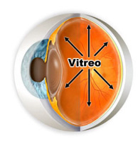 ¿Qué es el Desprendimiento de Vítreo?