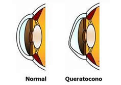¿Qué es  Queratocono?