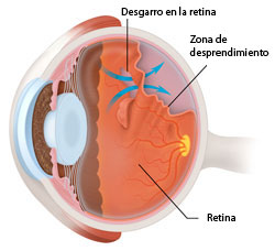 Lo que debes saber del Desprendimiento de Retina