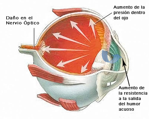 Tipos de Glaucoma