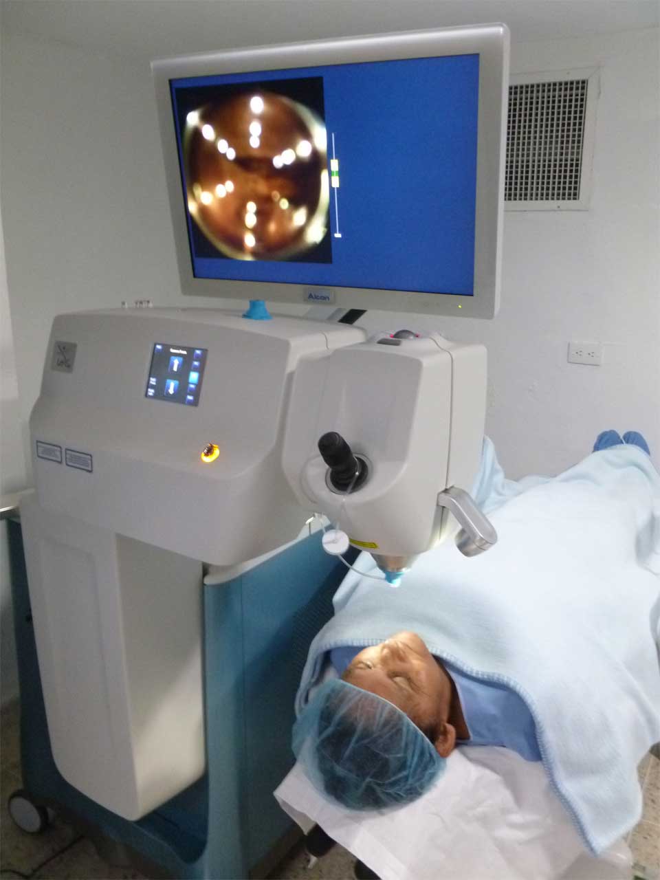 Cirugía de cataratas con láser LenSx