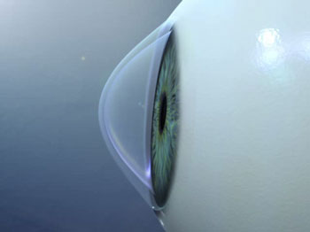 Lo que debe saber sobre el Queratocono