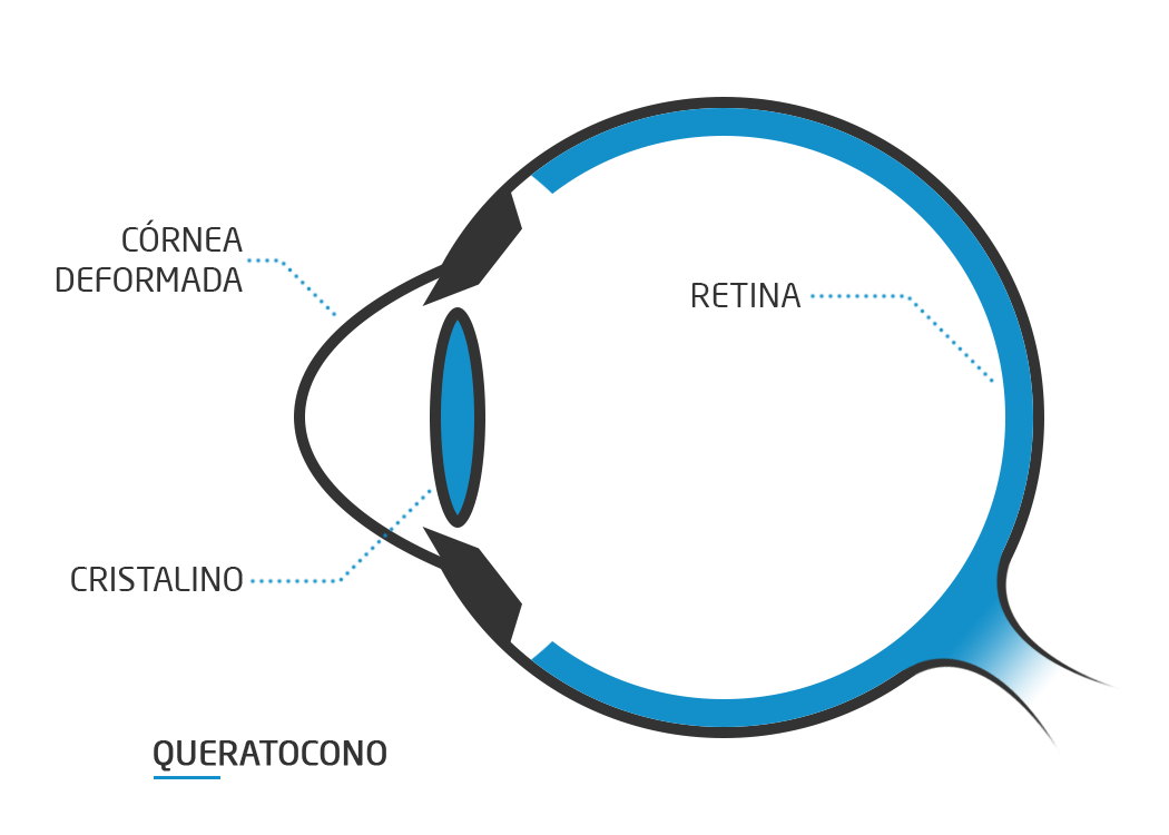¿Qué es Queratocono?