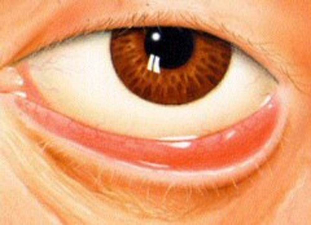 ¿Qué es ectropión?