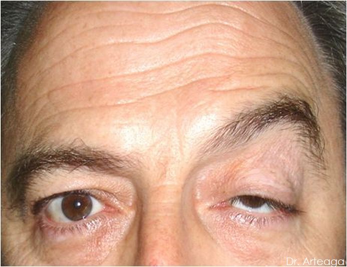 ¿Qué es Ptosis?