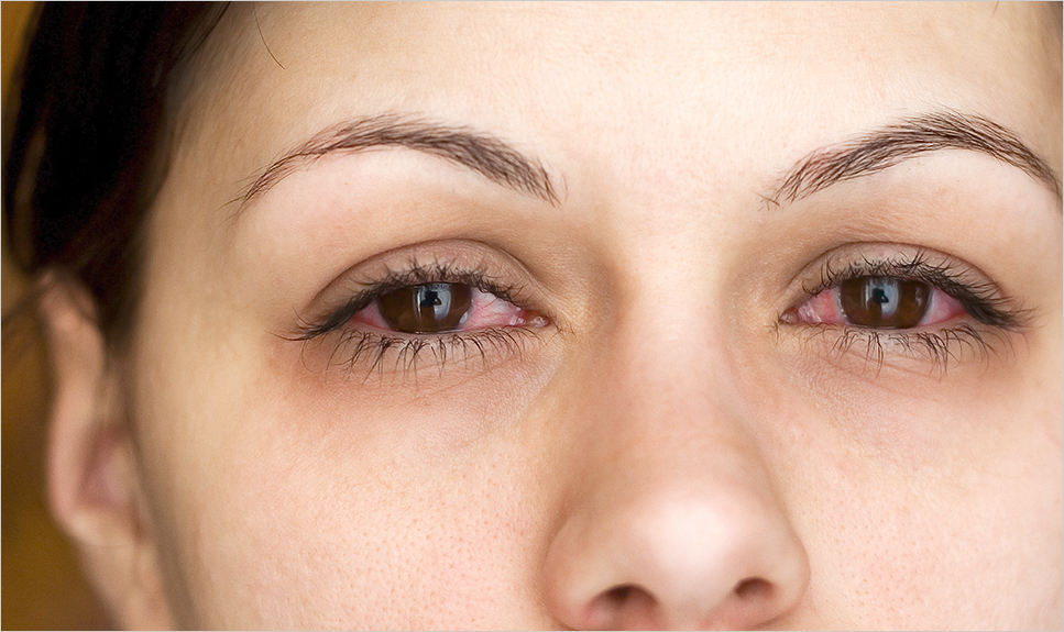 La uveítis, diagnosticarla a tiempo puede salvarte la vista.