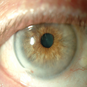 Queratitis neurotrófica ¿Qué es?