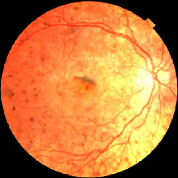 ¿Qué es la Retinosis Pigmentaria?