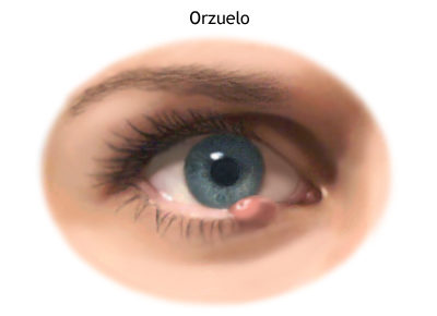 Orzuelos
