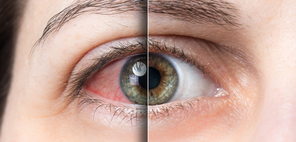 ¿Qué es el síndrome del ojo seco?