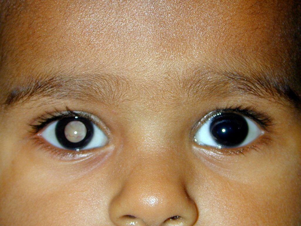 Retinoblastoma: El cáncer ocular más común en niños