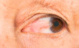 ¿Qué es el Pterigión? El famoso “terigi” en nuestro clima tropical